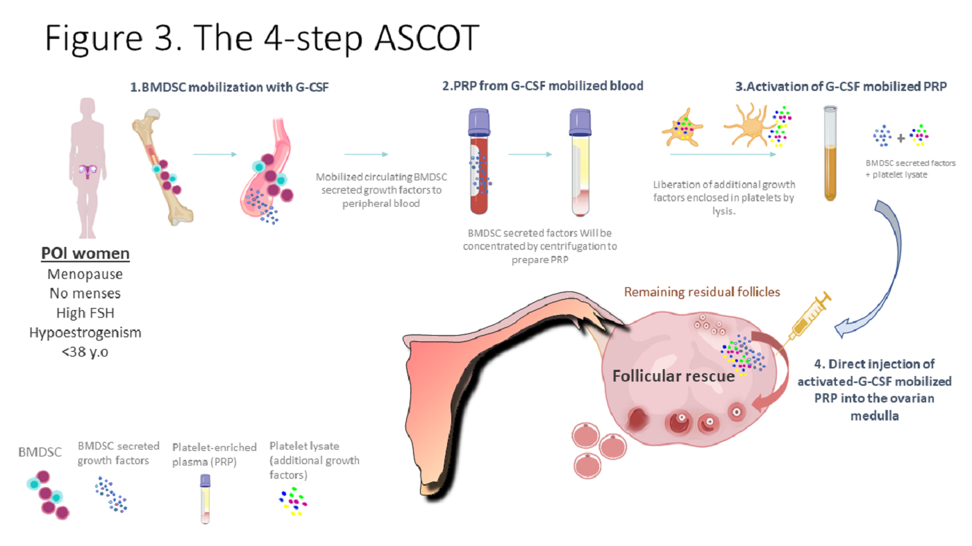 4-step ASCOT: Una técnica para mujeres con fallo ovárico prematuro