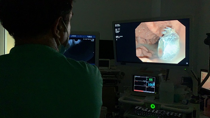 El Hospital Universitario del Vinalopó implanta una nueva prótesis para tratar las complicaciones de la pancreatitis aguda